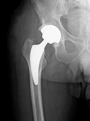 Protesi totale anca dx - post