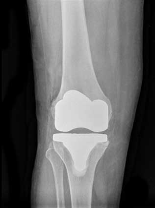 Protesi ginocchio totale
